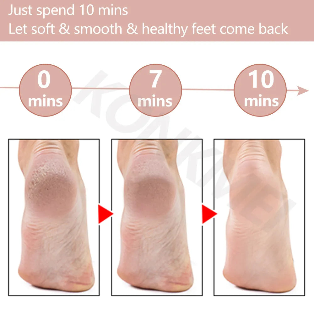 SoftTouch™ Callus Remover